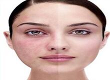 لکه های پوستی چرا و چگونه به وجود می آیند