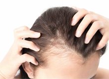 چهار توصیه مهم برای کسانی که ریزش مو دارند