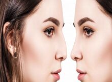 عمل بینی چگونه انجام می شود؟
