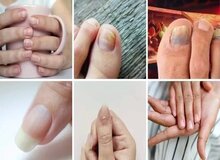 ۷ علامت هشداردهنده کلسترول بالا در ناخن