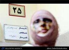 زندگی تلخ دختر قربانی اسیدپاشی/حتی برای خرید غذا پول ندارم /عامل اسیدپاشی از زندان تماس گرفت و گفت شوهر کرده ام،بیا در مراسم عروسی من برقص