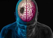 سکته مغزی ۱۴۰ هزار ایرانی در سال