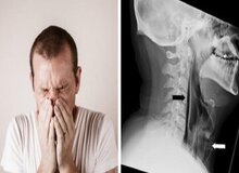 سوراخ شدن گلو بر اثر نگهداشتن عطسه/ عکس