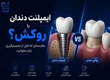 ایمپلنت دندان یا روکش؟ مقایسه‌ای که قبل از تصمیم‌گیری باید بخوانید