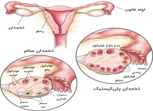 علائم کیست تخمدان چیست؟