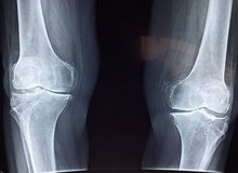 تشخیص علائم اولیه پوکی استخوان با هوش مصنوعی