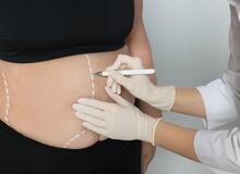 تفاوت ابدومینوپلاستی با لیپوماتیک چیست؟ لیپوماتیک بهتره یا ابدومینوپلاستی