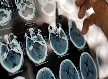 یک عامل مهم و کمتر گفته شده درباره روند پیشرفت آلزایمر