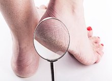 ترک پا یعنی کمبود سه ویتامین/ این ویتامین‌ها چیست؟

