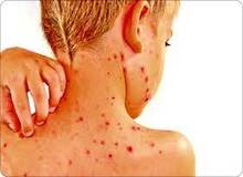 آبله میمون چیست و چه علائمی دارد