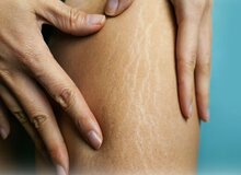 سلولیت چیست؟/۵ عامل ایجاد سلولیت در پوست