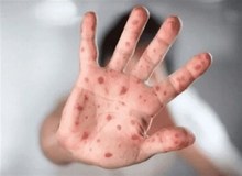 همه چیز درباره شیوع HFMD در مدارس/ کدام دانش‌آموزان نباید به مدرسه بروند؟