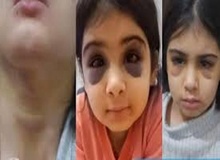 شکنجه و آزار دختربچه ۹ ساله سنندجی توسط  نامادری/ نامادری با گوشت کوب به سر کودک می کوبید و با چنگال  بدنش را می سوزاند