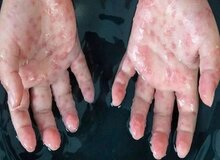 بیش از ۵۰ هزارنفر به آبله میمون مبتلا شدند