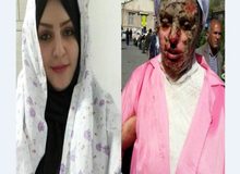 دانشگاه علوم پزشکی تبریز: هزینه‎ای برای درمان قربانی اسیدپاشی دریافت نشده است