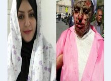 دانشگاه علوم پزشکی تبریز: هزینه‎ای برای درمان قربانی اسیدپاشی دریافت نشده است