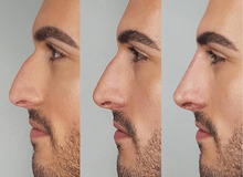 انجام عمل جراحی بینی برای این ۱۹ گروه بسیار خطرناک است